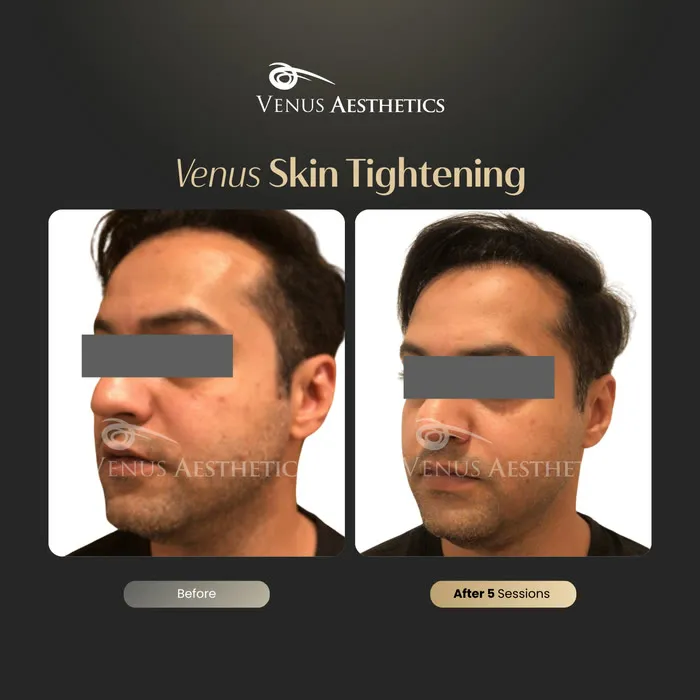 Skin tightening before and after result at Luxeria Clinic