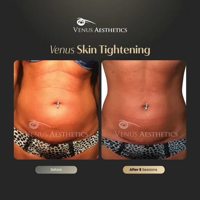 Skin tightening before and after result at Luxeria Clinic