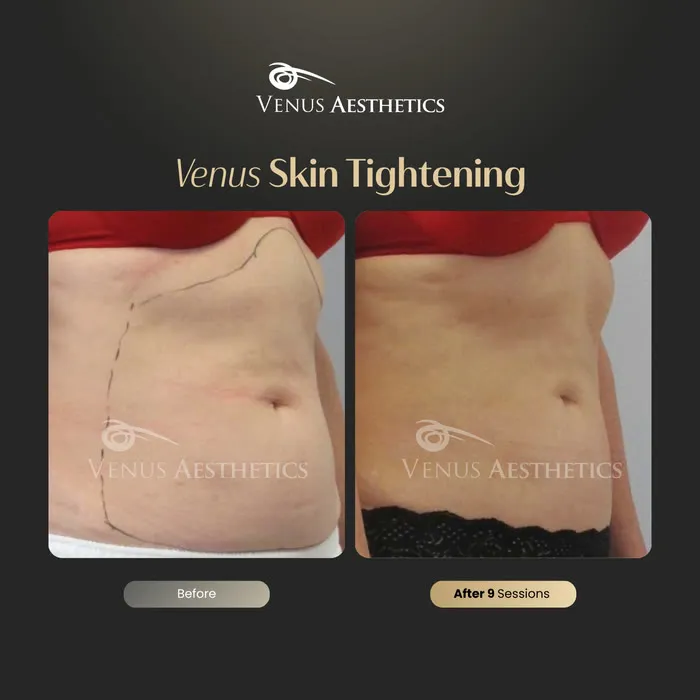 Skin tightening before and after result at Luxeria Clinic