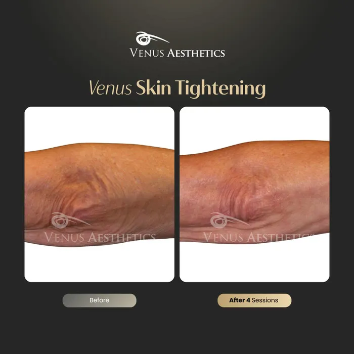 Skin tightening before and after result at Luxeria Clinic