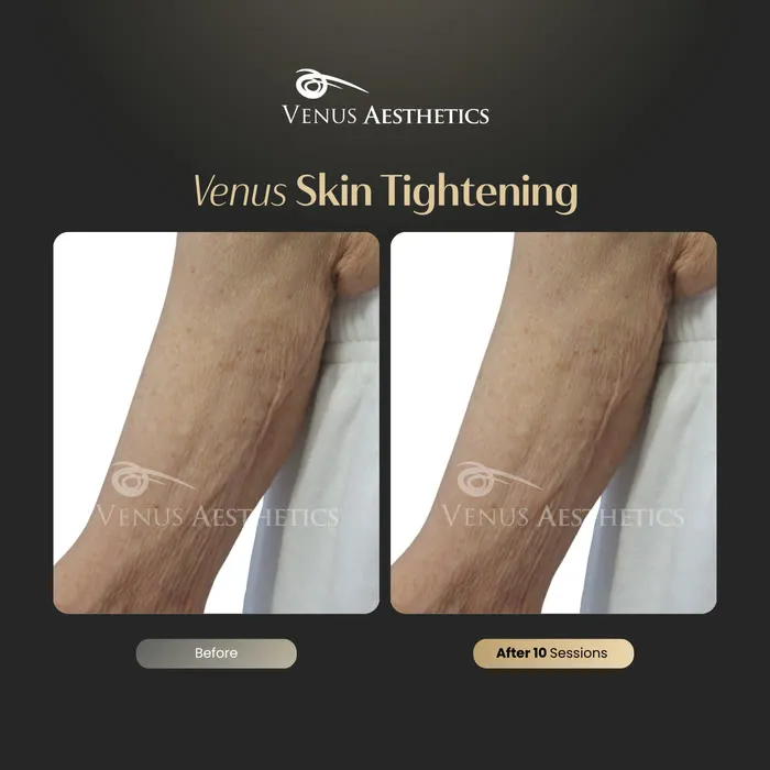 Skin tightening before and after result at Luxeria Clinic