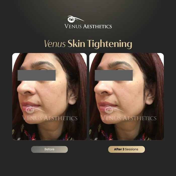 Skin tightening before and after result at Luxeria Clinic