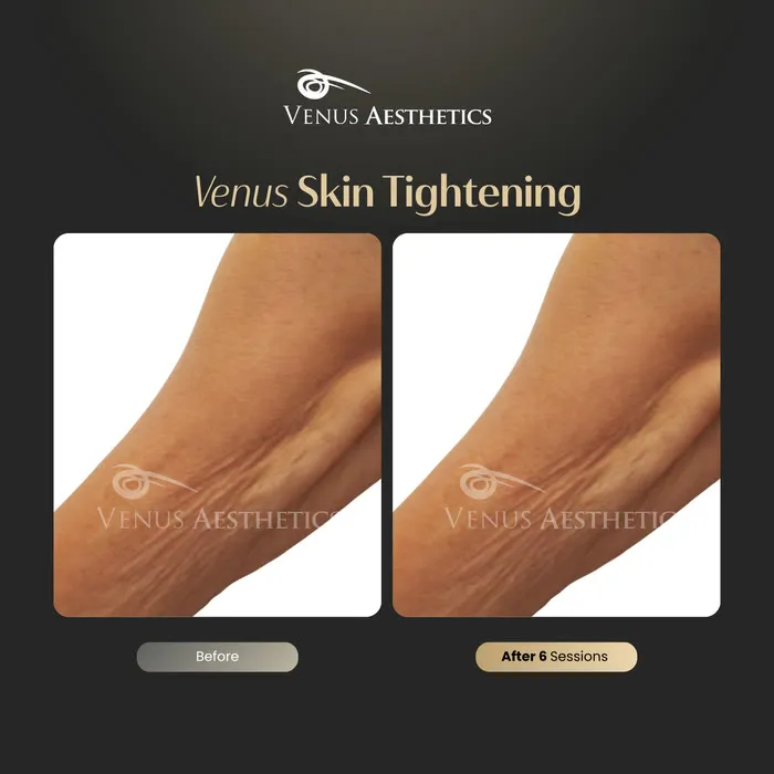 Skin tightening before and after result at Luxeria Clinic