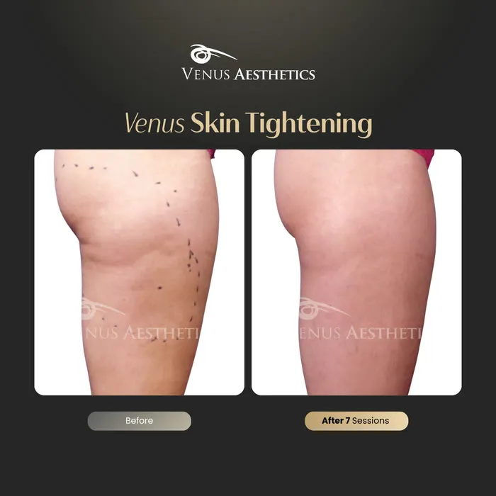 Skin tightening before and after result at Luxeria Clinic