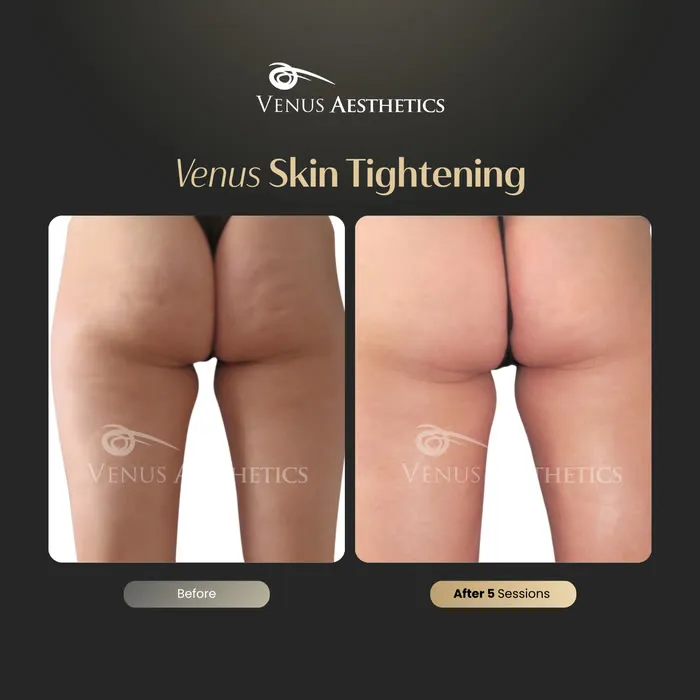 Skin tightening before and after result at Luxeria Clinic