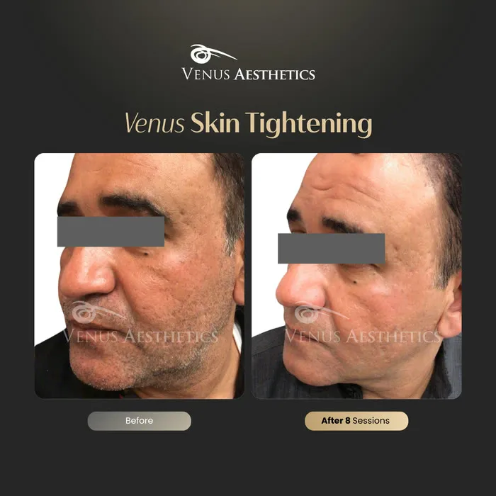 Skin tightening before and after result at Luxeria Clinic