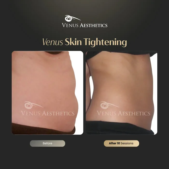Skin tightening before and after result at Luxeria Clinic
