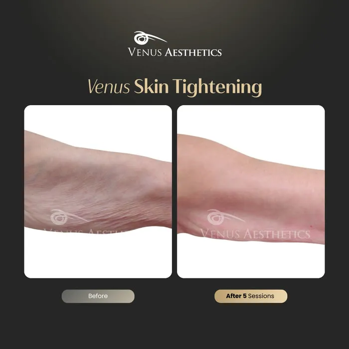 Skin tightening before and after result at Luxeria Clinic