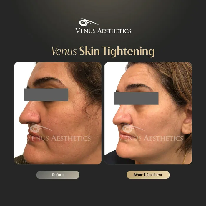 Skin tightening before and after result at Luxeria Clinic