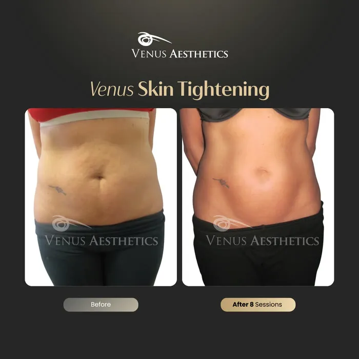 Skin tightening before and after result at Luxeria Clinic