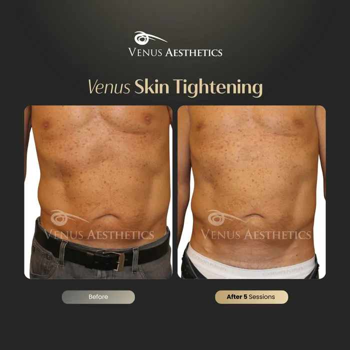 Skin tightening before and after result at Luxeria Clinic