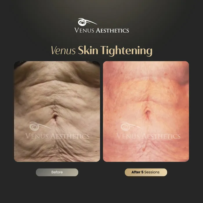 Skin tightening before and after result at Luxeria Clinic