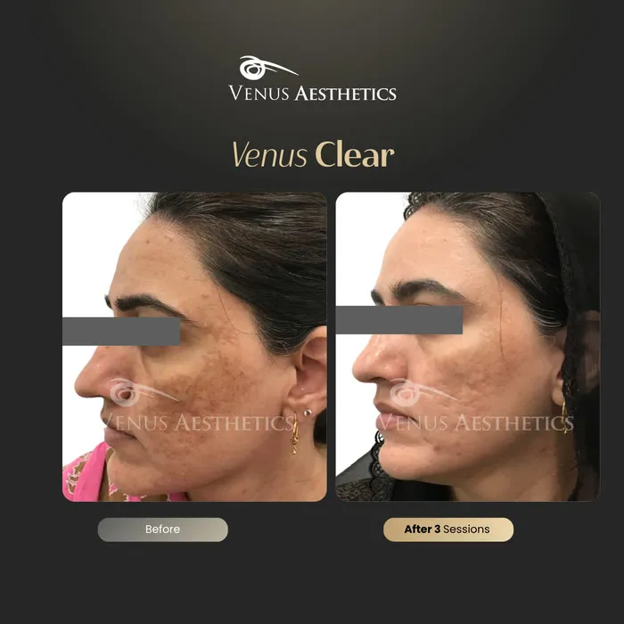 luxeria Clear pigmentation before and after result at Luxeria Clinic