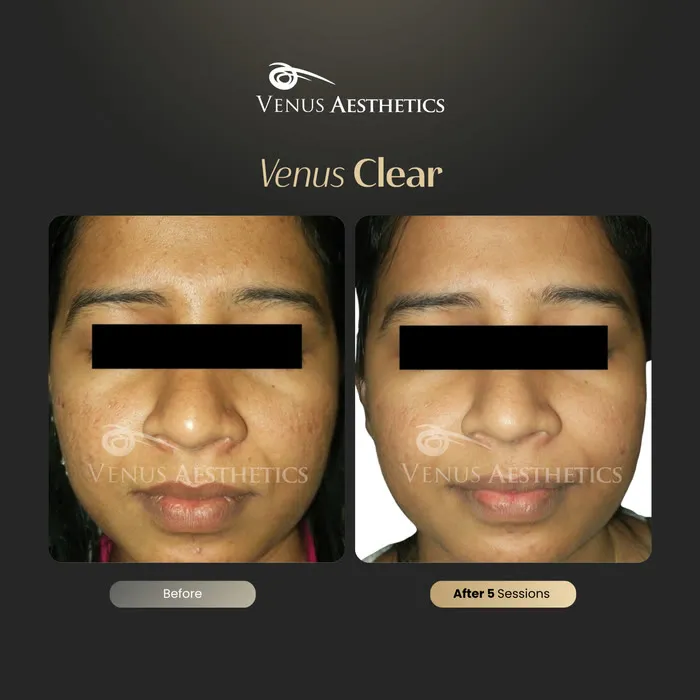 luxeria Clear pigmentation treatment before and after photo of an actual Luxeria Clinic client, 10 of 16