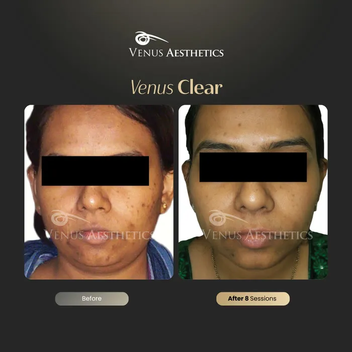 luxeria Clear pigmentation treatment before and after photo of an actual Luxeria Clinic client, 11 of 16
