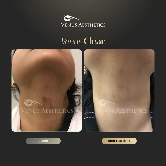 luxeria Clear pigmentation before and after result at Luxeria Clinic