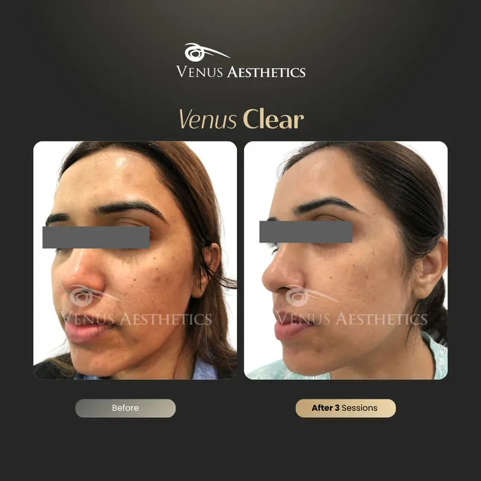 luxeria Clear pigmentation treatment before and after photo of an actual Luxeria Clinic client, 13 of 16