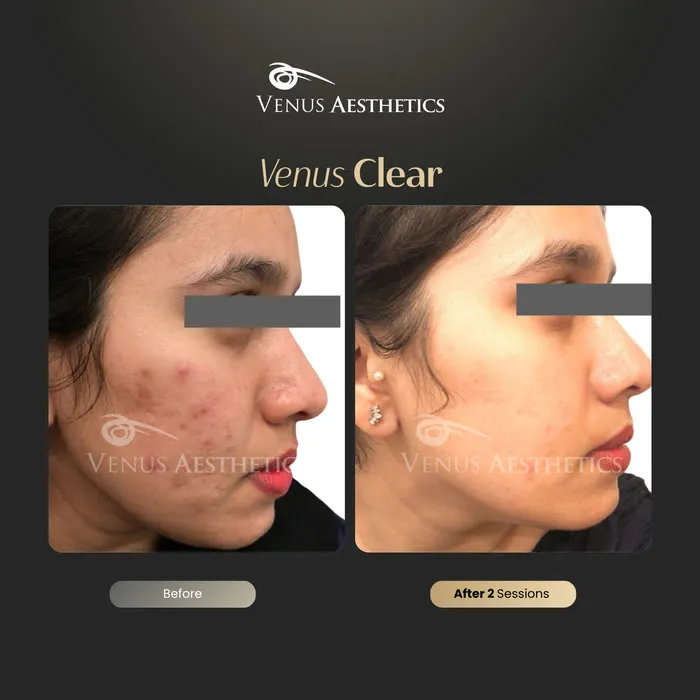 luxeria Clear pigmentation before and after result at Luxeria Clinic