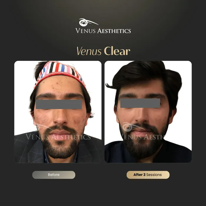 luxeria Clear pigmentation before and after result at Luxeria Clinic
