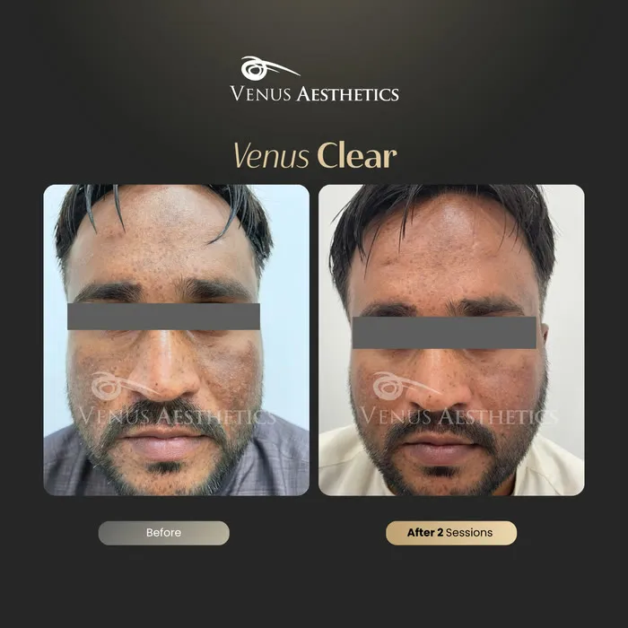 luxeria Clear pigmentation before and after result at Luxeria Clinic