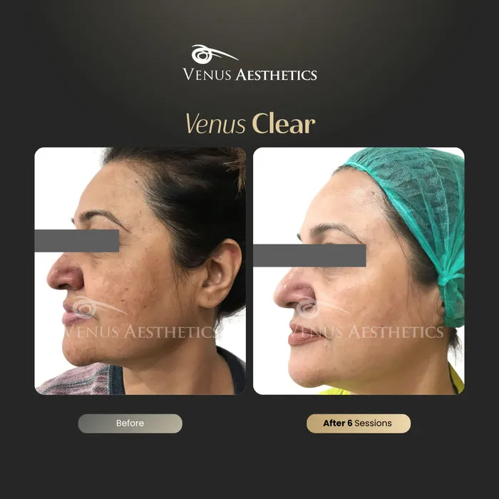luxeria Clear pigmentation treatment before and after photo of an actual Luxeria Clinic client, 2 of 16
