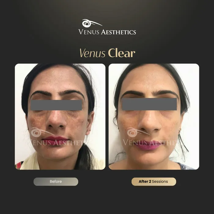 luxeria Clear pigmentation before and after result at Luxeria Clinic