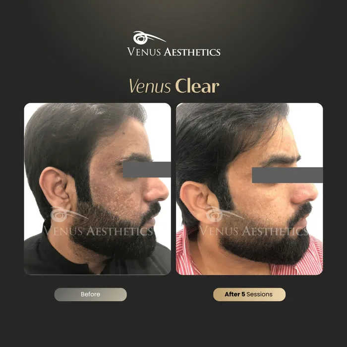 luxeria Clear pigmentation before and after result at Luxeria Clinic