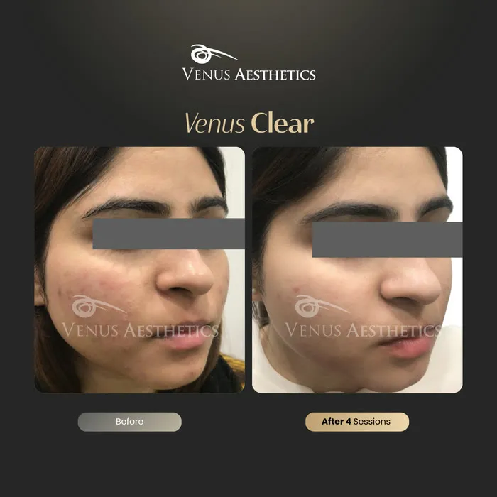 luxeria Clear pigmentation before and after result at Luxeria Clinic