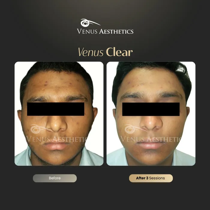 luxeria Clear pigmentation before and after result at Luxeria Clinic
