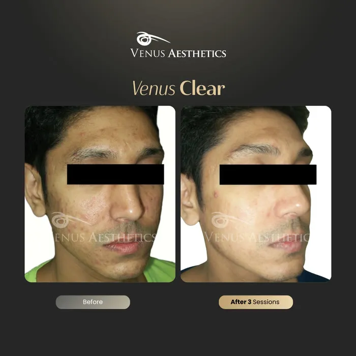 luxeria Clear pigmentation before and after result at Luxeria Clinic