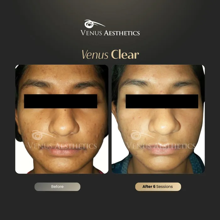 luxeria Clear pigmentation before and after result at Luxeria Clinic