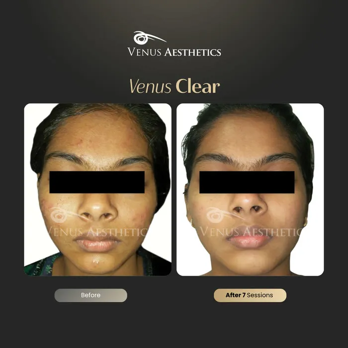 luxeria Clear pigmentation before and after result at Luxeria Clinic