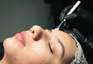 AcneOUT Peel at Luxeria Clinic