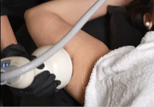 Upper-Arm Firming (Bingo Wings) at Luxeria Clinic