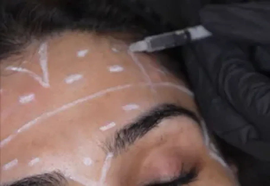 Forehead & Frown Lines at Luxeria Clinic