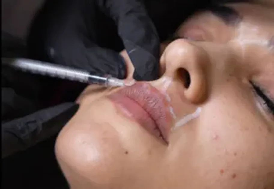 Lip Flip at Luxeria Clinic