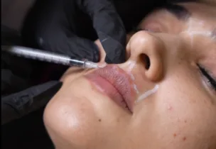 Lip Flip at Luxeria Clinic