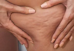 Cellulite smoothing treatment at Luxeria Clinic