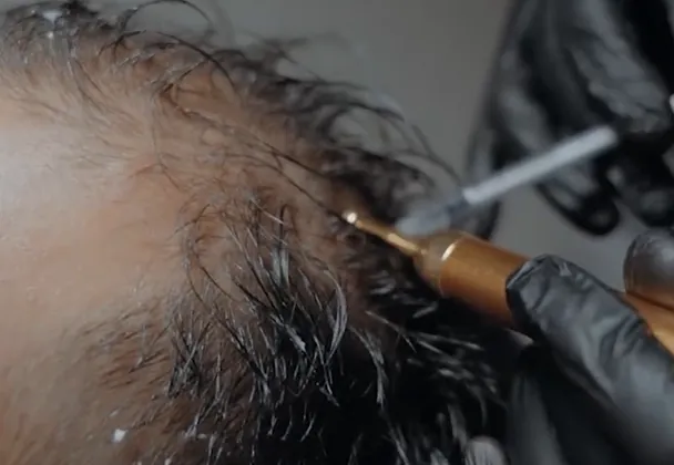 Hair Mesotherapy at Luxeria Clinic