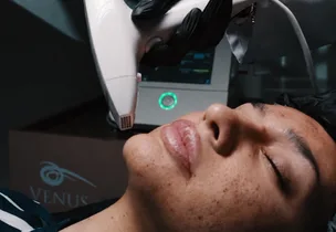 Skin rejuvenation session for pigmentation at Luxeria Clinic