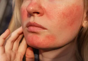 Rosacea & Redness at Luxeria Clinic