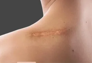 Advanced scar treatment technology at Luxeria Clinic