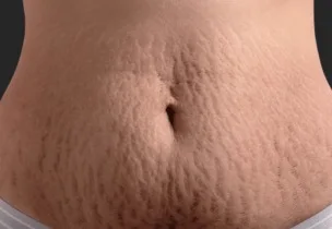 Body treatment session on the abdomen at Luxeria Clinic