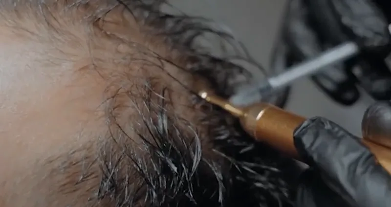 A doctor giving scalp micro-injections at Luxeria Clinic